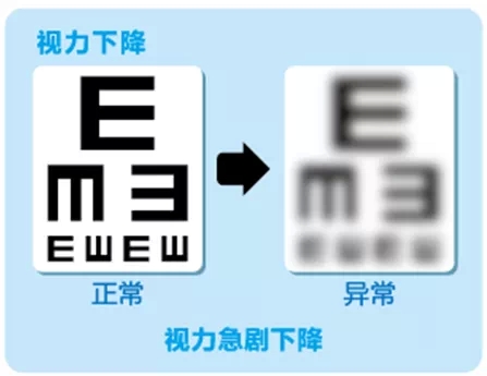 視網(wǎng)膜脫離啥癥狀？這張圖告訴你！