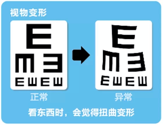 視網(wǎng)膜脫離啥癥狀？這張圖告訴你！