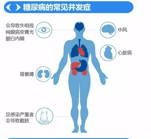 你造嗎？糖尿病晚期眼睛會致盲！