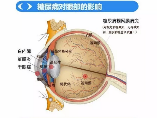 你造嗎？糖尿病晚期眼睛會致盲！