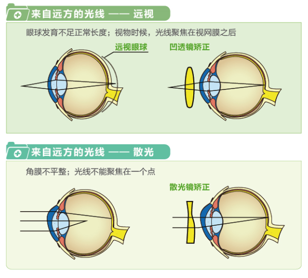 【看圖解】一張圖教你看懂近視、遠(yuǎn)視和散光