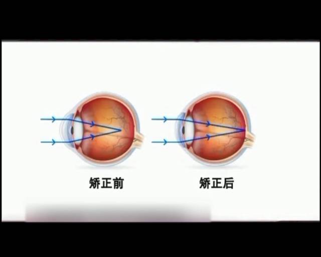 一夜之間真的能改變視力嗎？