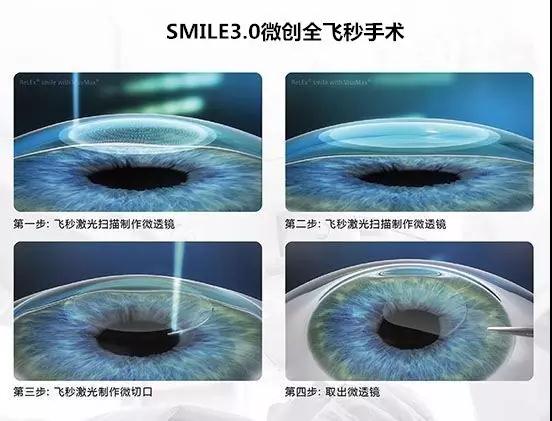 全國SMILE 之星手術(shù)視頻秀決賽 武漢普瑞眼科躋身前五