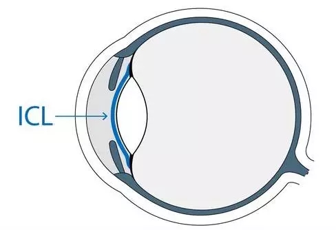想做ICL晶體植入術(shù)，你需要了解的全在這里!