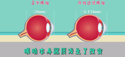 家長(zhǎng)該如何辨別孩子的真假性近視?